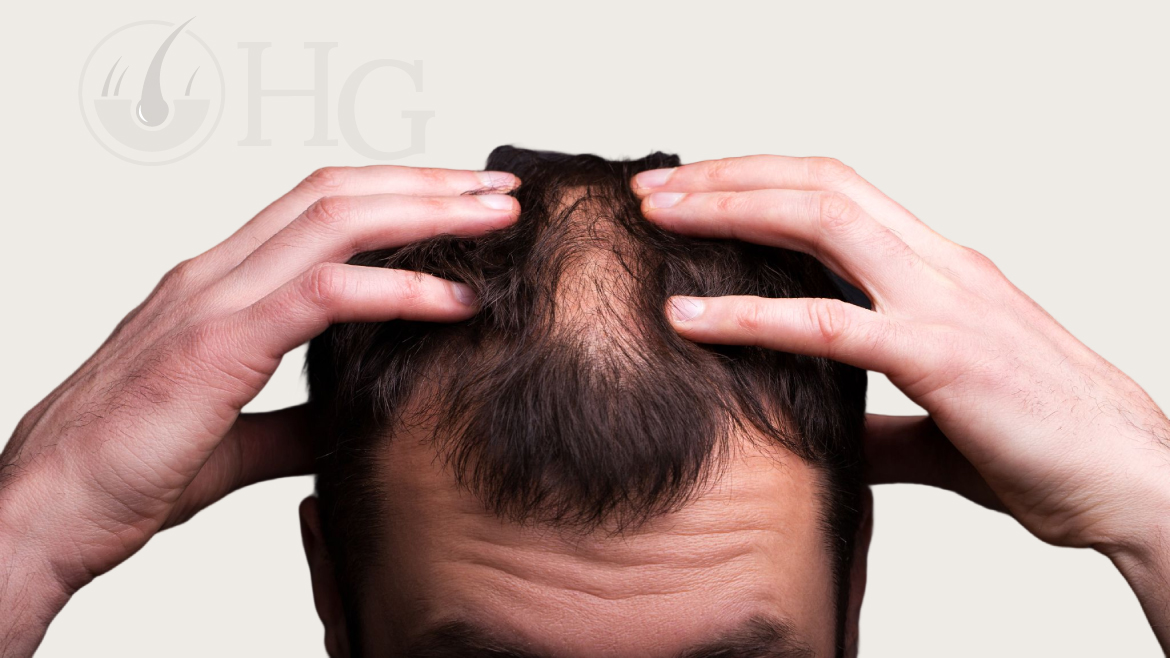 Hair Transplant