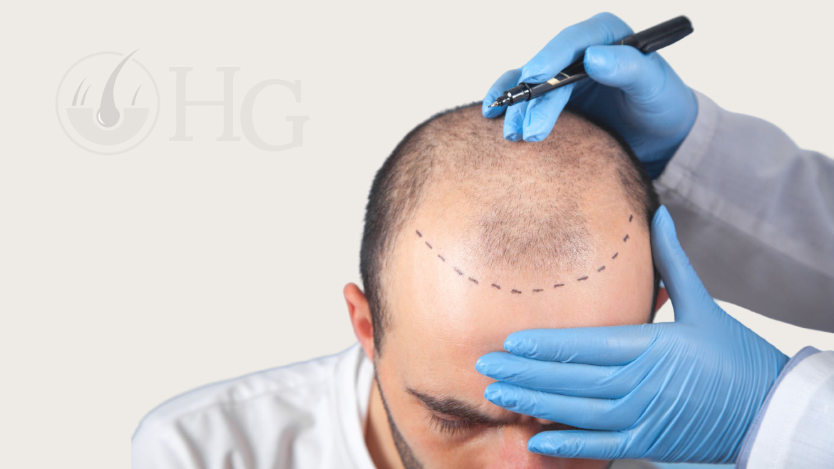 Hair Transplant