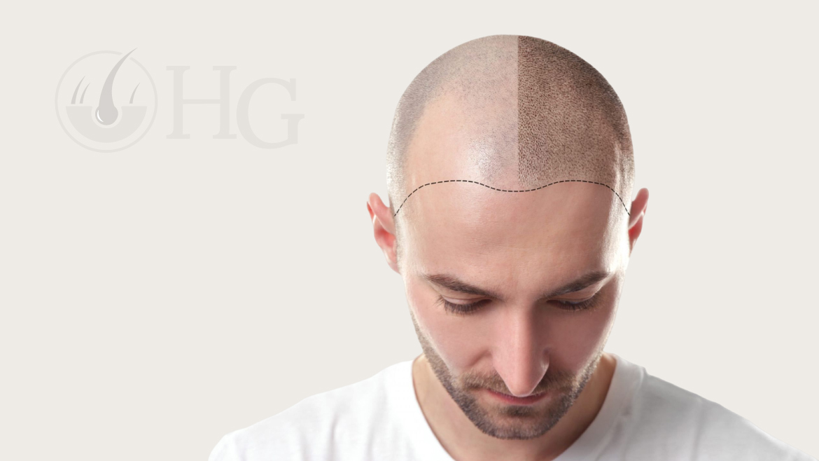 Hair Transplant